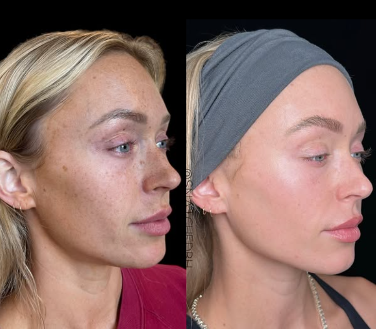 30-day skin reset with advanced brightening system including skincare products and peel — treats stubborn pigment from sun damage, age spots, acne scars, and melasma.